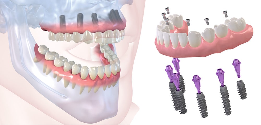 Восстановление зубов. Имплантация «All-on-6» в ОН КЛИНИК