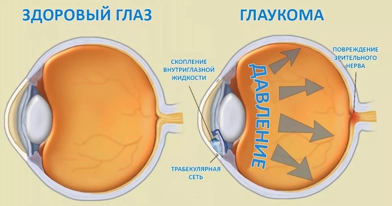 Схема здорового глаза человека и глаза с глаукомой