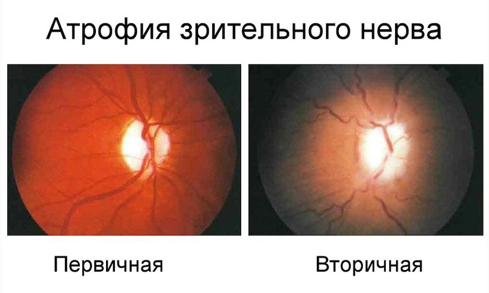 Атрофия зрительного нерва первичная и вторичная