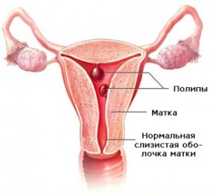 Полипы шейки матки