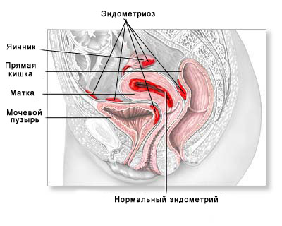 Противопоказания при эндометриозе.