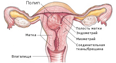 Железисто-фиброзный полип эндометрия