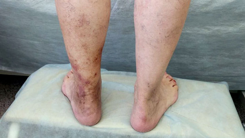 Эндовенозная лазерная коагуляция + минифлебэктомия | флеболог Кубанова Р.Р.