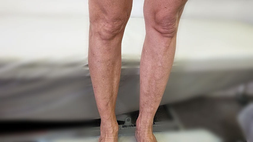 Лечение варикоза | флеболог Кубанова Р.Р.