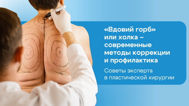 «Вдовий горб» или холка: современные методы коррекции и профилактика