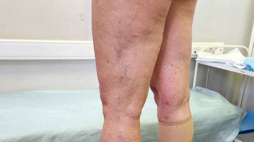 Лечение варикоза | флеболог Кубанова Р.Р.