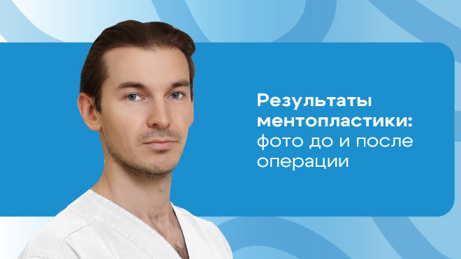 Результат ментопластики пластического хирурга, кмн Сорвина Владимира Андреевича