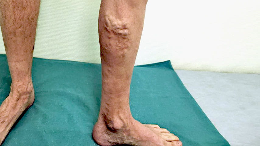 Эндовенозная лазерная коагуляция + минифлебэктомия | флеболог Кубанова Р.Р.