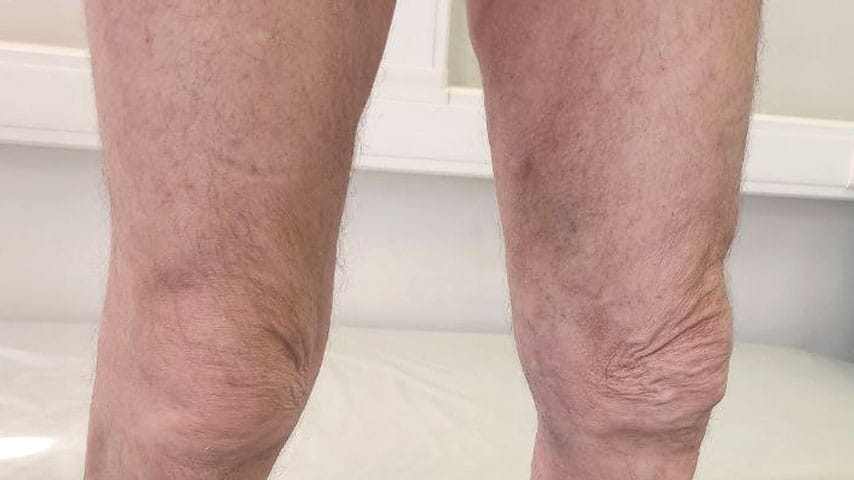 Лечение варикоза | флеболог Кубанова Р.Р.