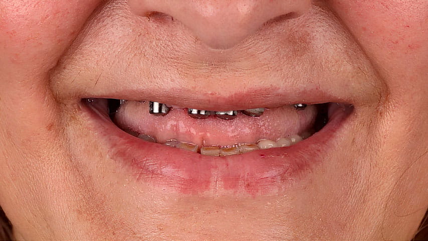 Имплантация зубов «All-on-4»