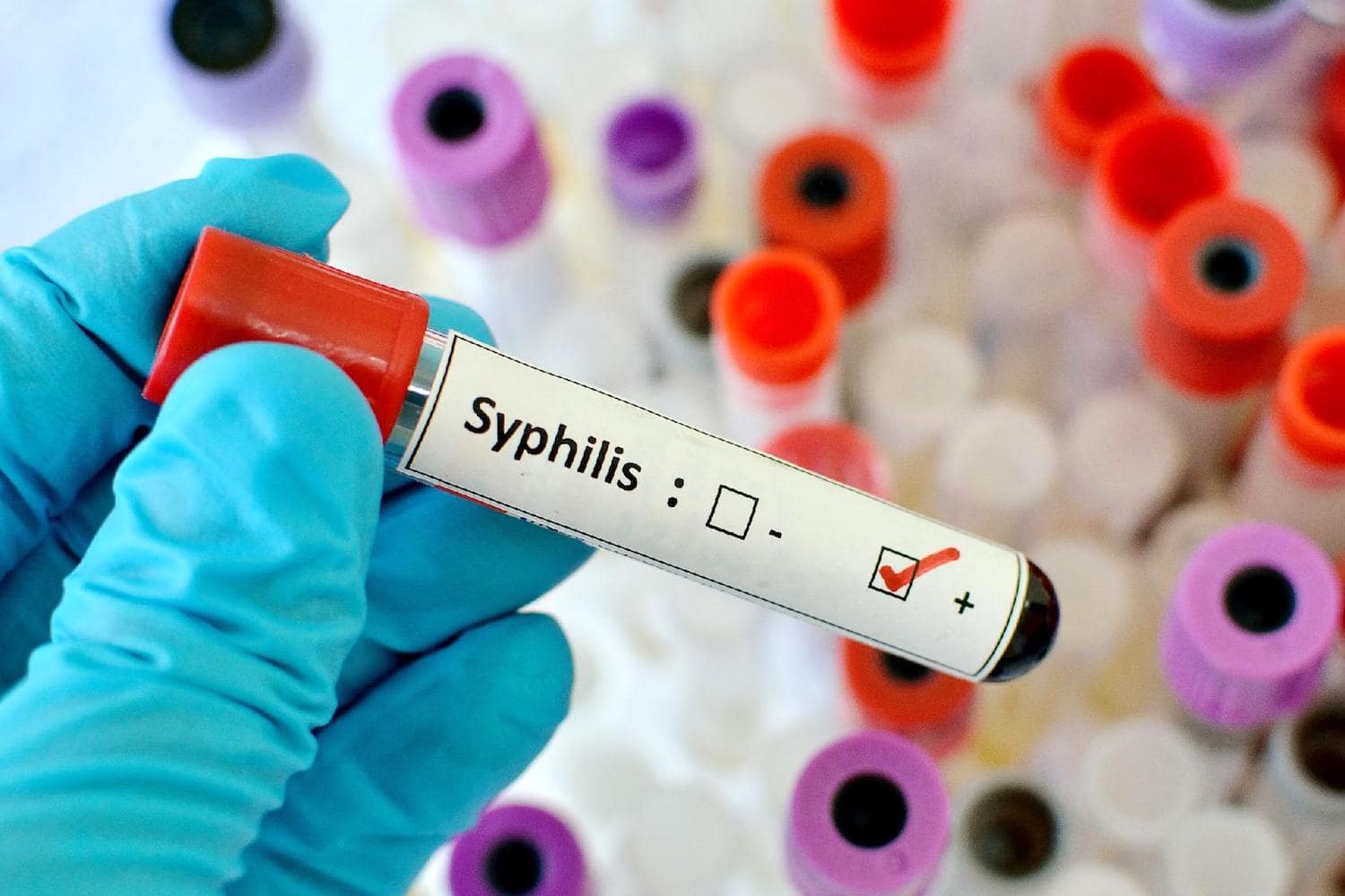 Положительный результат анализа на сифилис