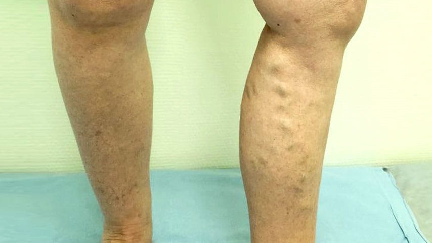 Лечение варикоза | флеболог Кубанова Р.Р.