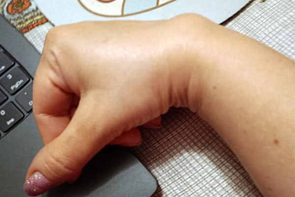 Лечение гигромы запястья