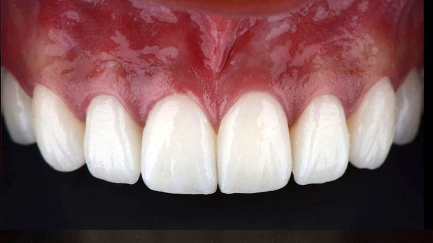 Люминиры на зубы