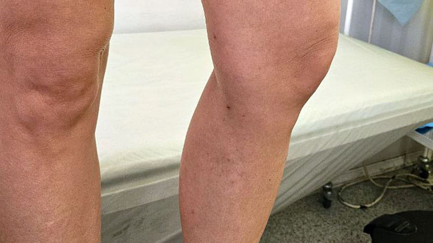 Лечение варикоза | флеболог Кубанова Р.Р.