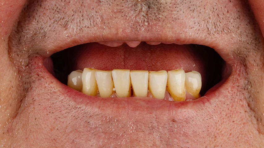 Имплантация зубов «All-on-4»