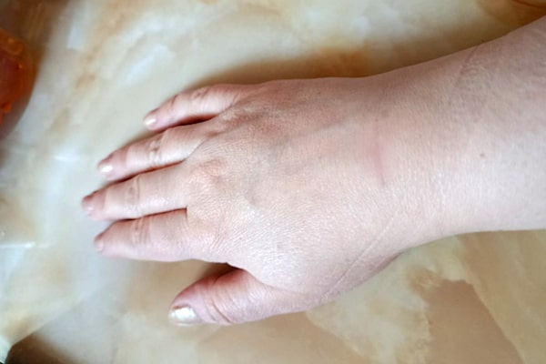 Лечение гигромы запястья