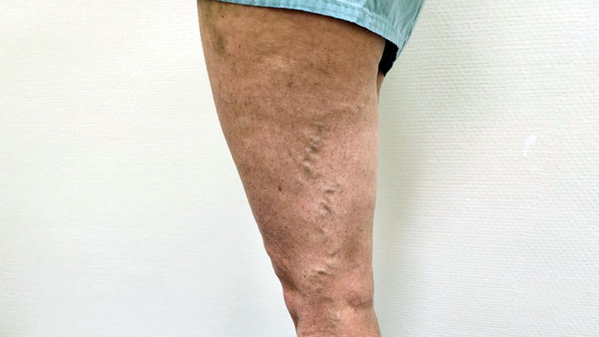 Лечение варикоза | флеболог Кубанова Р.Р.