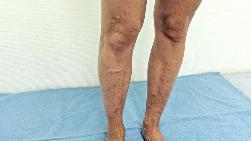 Лечение варикоза | флеболог Кубанова Р.Р.