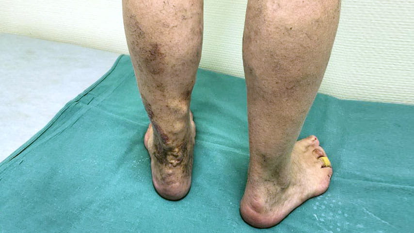 Эндовенозная лазерная коагуляция + минифлебэктомия | флеболог Кубанова Р.Р.