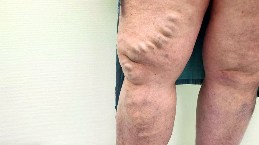 Эндовенозная лазерная коагуляция + минифлебэктомия | флеболог Кубанова Р.Р.