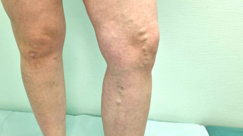 Лечение варикоза | флеболог Кубанова Р.Р.