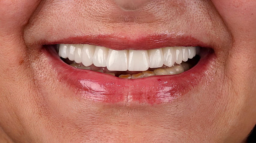 Имплантация зубов «All-on-4»