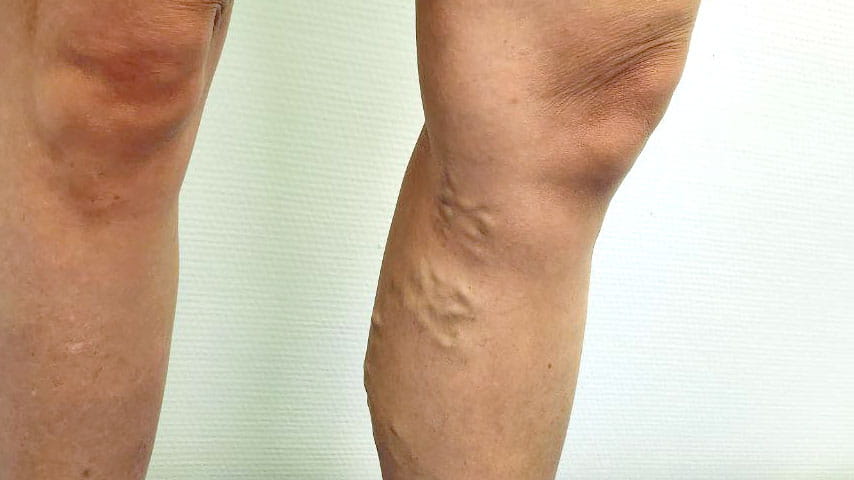 Лечение варикоза | флеболог Кубанова Р.Р.
