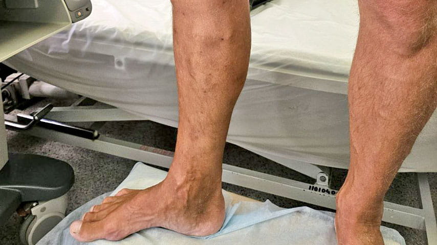 Эндовенозная лазерная коагуляция + минифлебэктомия | флеболог Кубанова Р.Р.