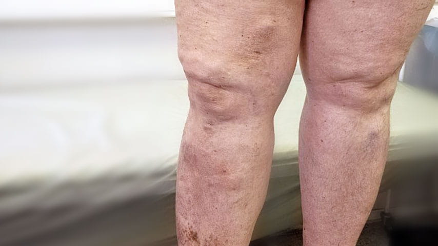 Эндовенозная лазерная коагуляция + минифлебэктомия | флеболог Кубанова Р.Р.