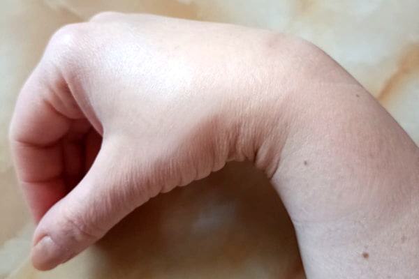 Лечение гигромы запястья