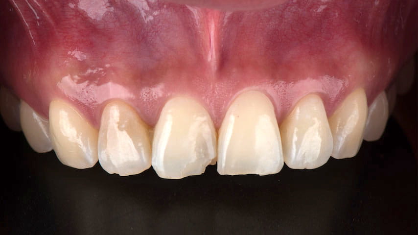 Люминиры на зубы