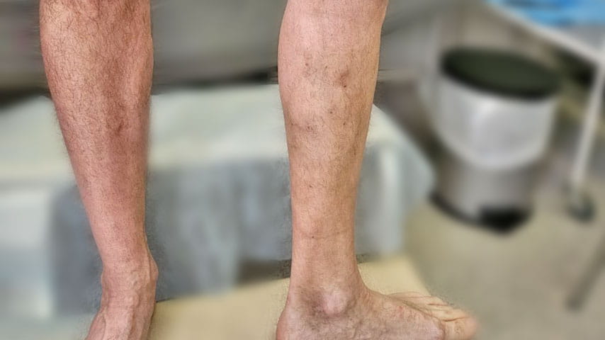 Эндовенозная лазерная коагуляция + минифлебэктомия | флеболог Кубанова Р.Р.