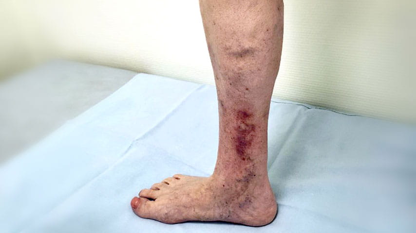 Эндовенозная лазерная коагуляция + минифлебэктомия | флеболог Кубанова Р.Р.