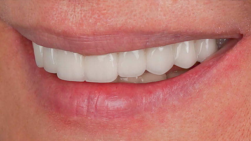 Имплантация зубов «All-on-4»