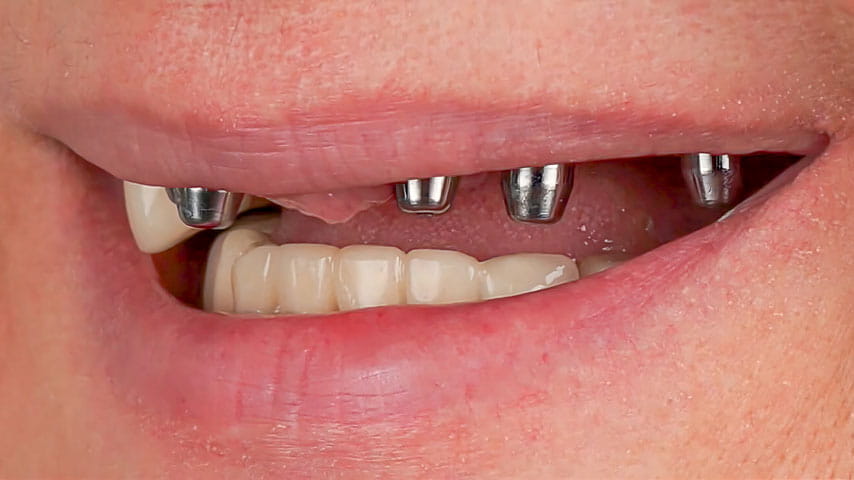 Имплантация зубов «All-on-4»