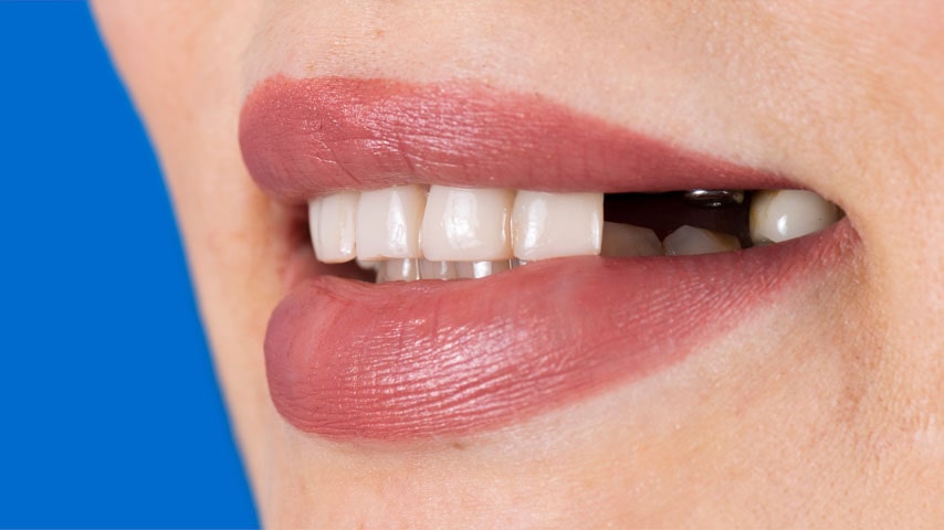 Имплантация зубов