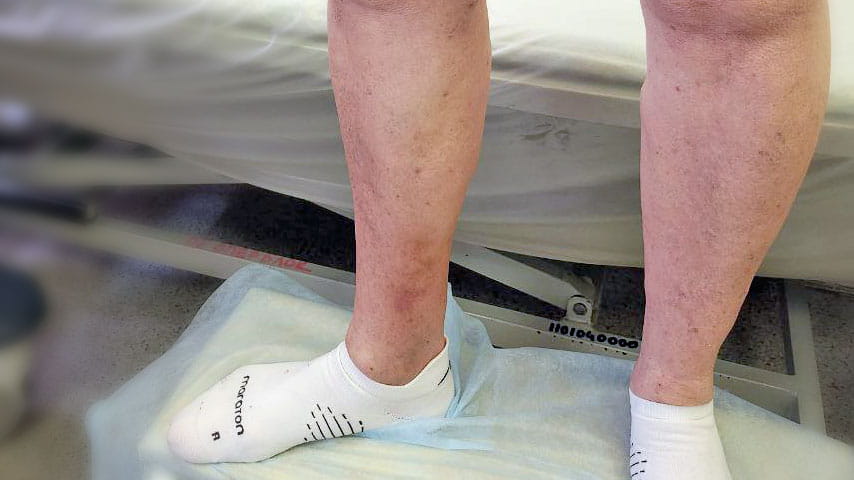 Эндовенозная лазерная коагуляция + минифлебэктомия | флеболог Кубанова Р.Р.