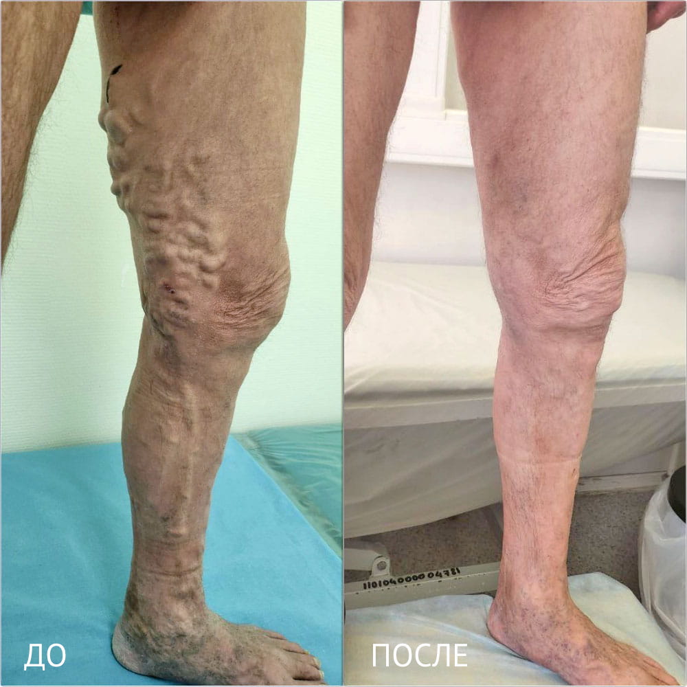 Результаты операции по лечению варикоза – фото до и через месяц после операции. Флеболог ОН КЛИНИК Кубанова Радмила Руслановна
