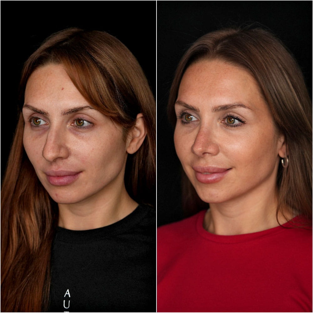 Результат ринопластики – фото до и после операции