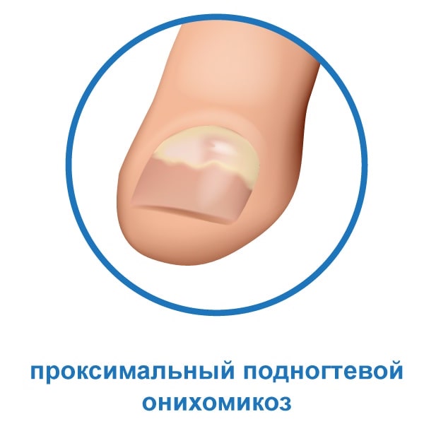 Проксимальный подногтевой онихомикоз Проксимальный подногтевой онихомикоз