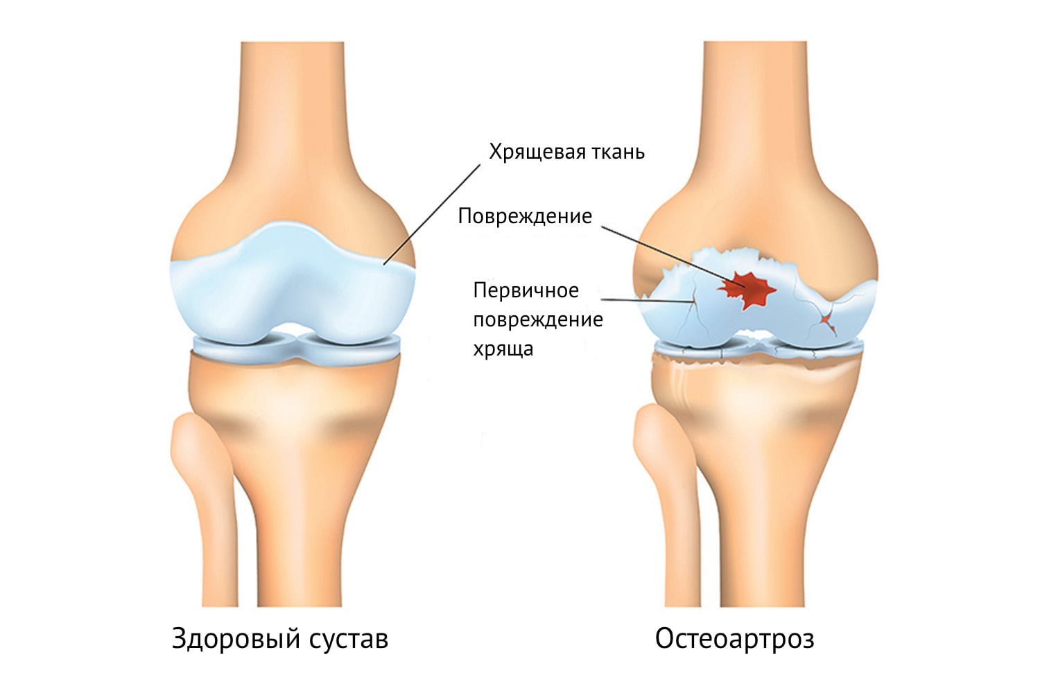 Лечение остеоартроза суставов в ОН КЛИНИК