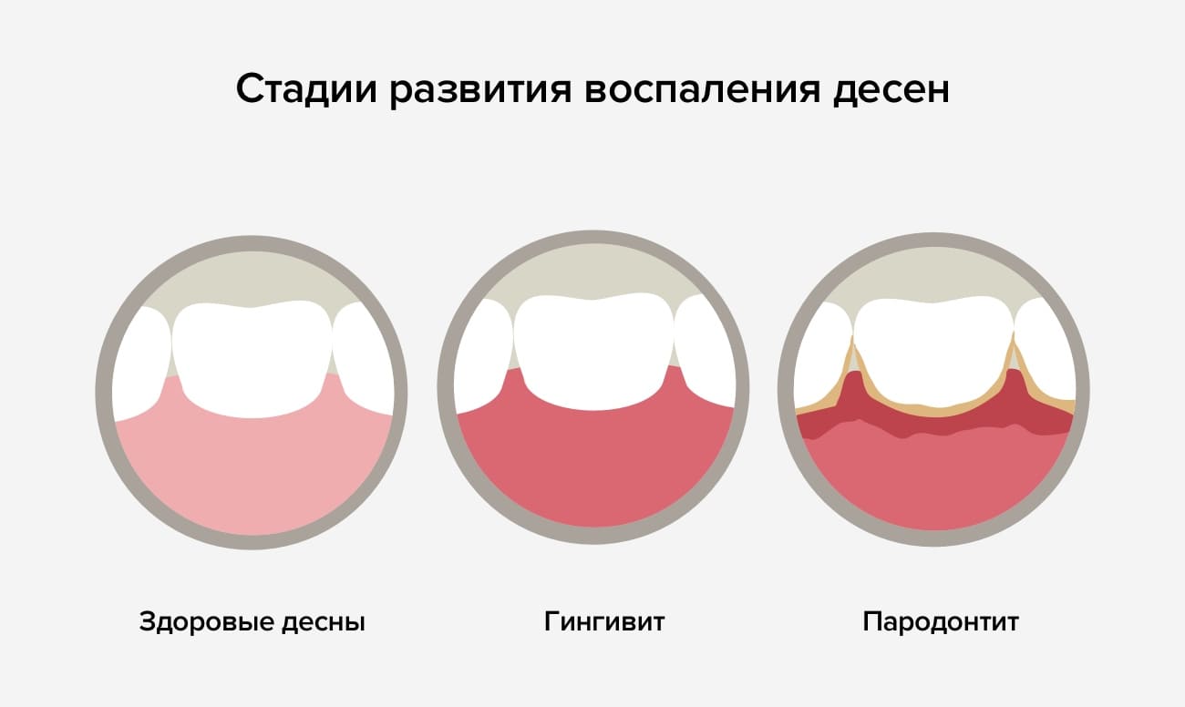 Стадии заболевания десен