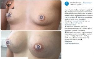 mammoplastika-inst.jpg mammoplastika-inst.jpg