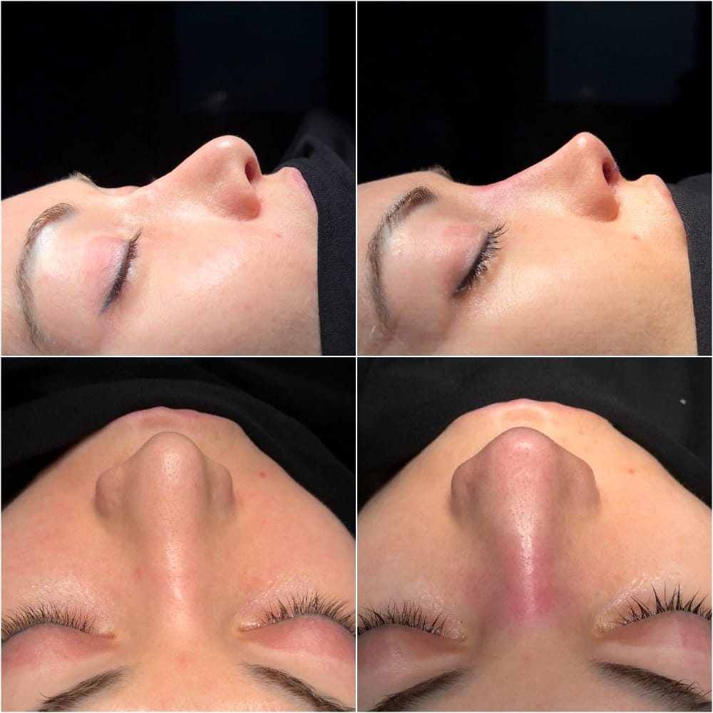 Результат ринопластики – фото до и после операции в ОН КЛИНИК