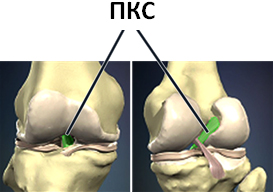Разрыв передней крестообразной связки