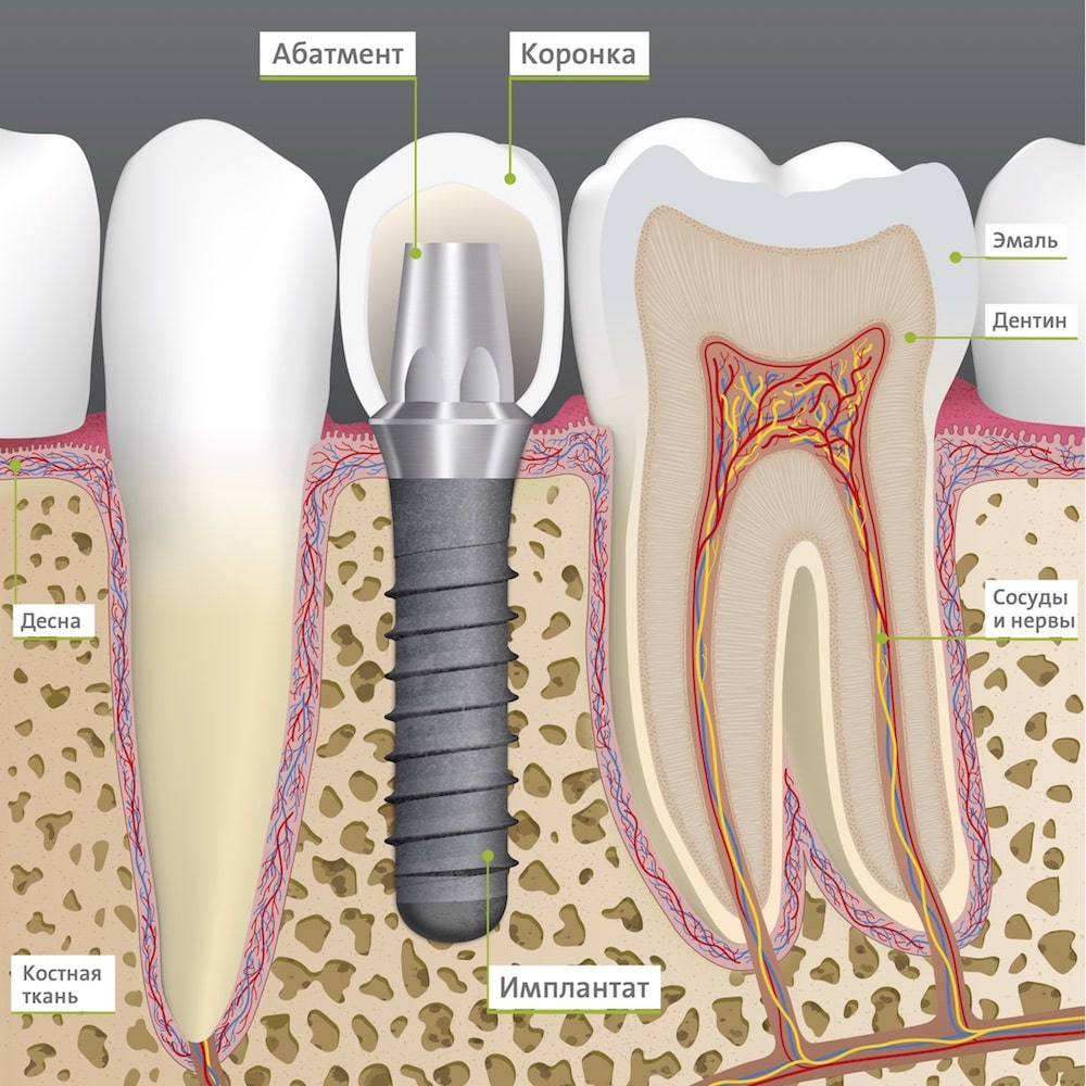 Имплантация зубов в ОН КЛИНИК