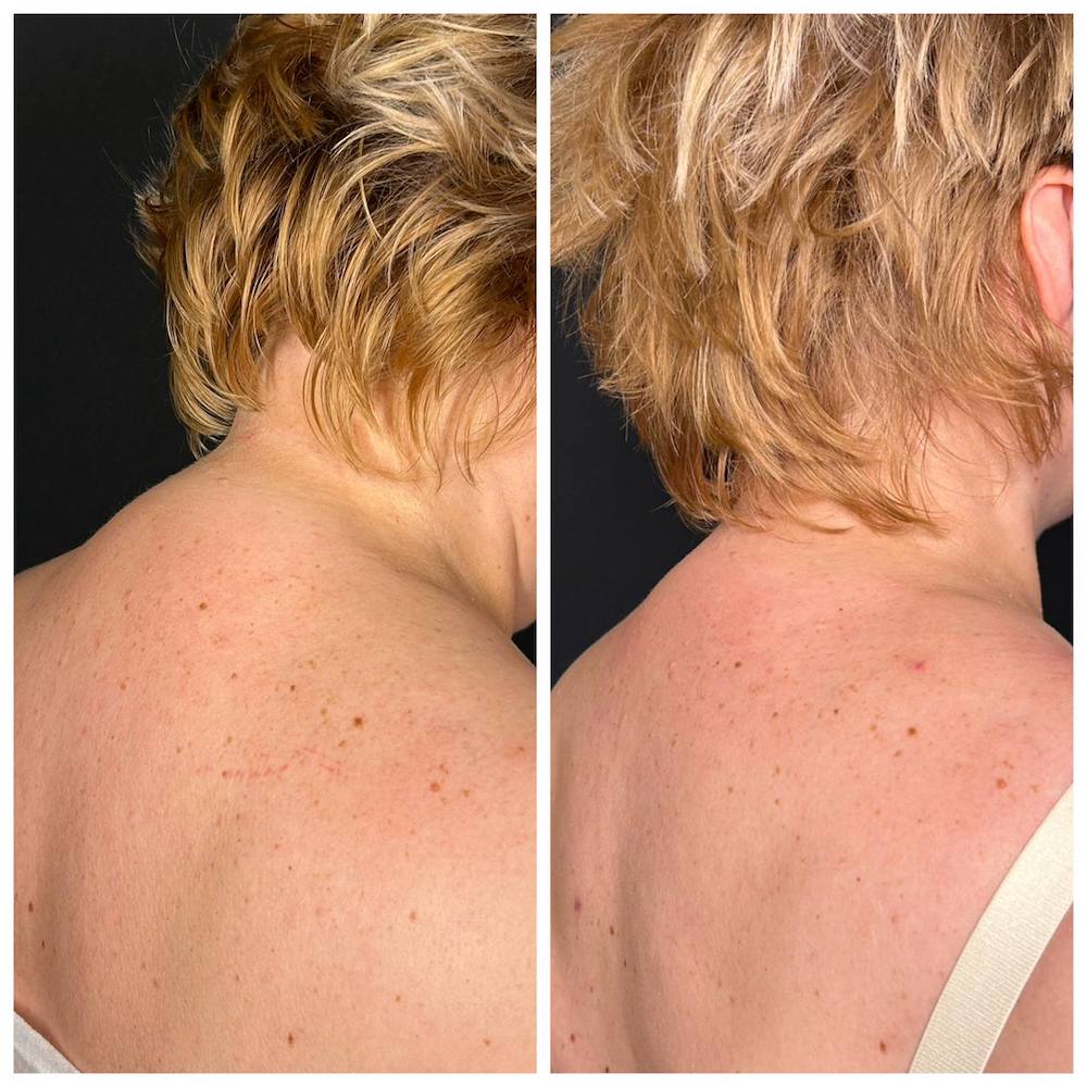 Липосакция холки: результат операции. Пластический хирург ОН КЛИНИК Тарасов Максим Дмитриевич