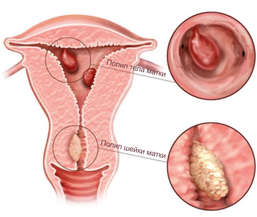 Полип тела и шейки матки