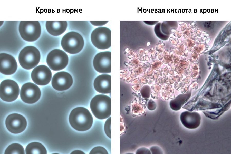 Кровь в норме и при наличии мочевой кислоты